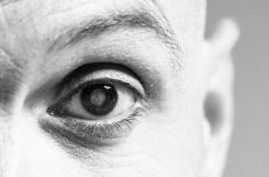 Диабетическая катаракта: причины, симптомы, лечение