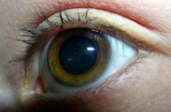 Лечение глаукомы при сахарном диабете: проблемы со зрением у диабетиков
