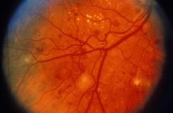 Что такое диабетическая ретинопатия и как ее лечить?