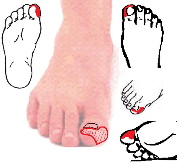 Сахарный диабет и онемение больших пальцев ног thumbnail