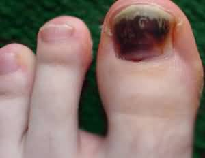 Потемнение ногтя на большом пальце ноги при диабете thumbnail