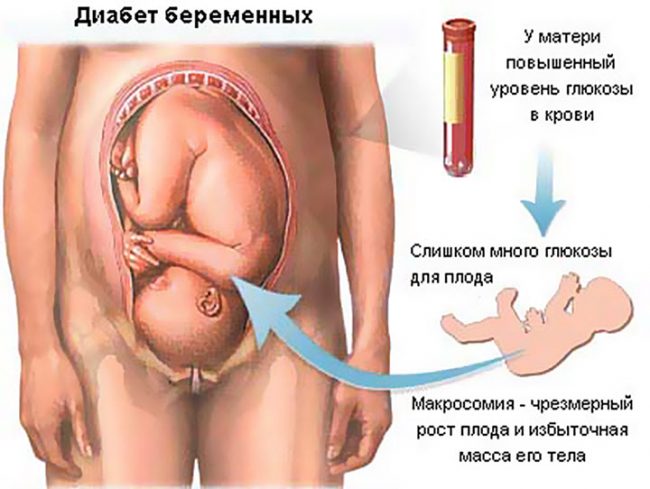 Гестационный сахарный диабет при беременности родоразрешение thumbnail