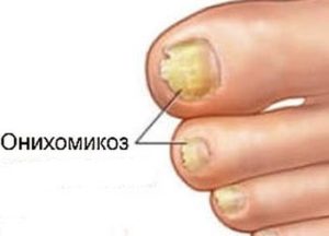Большой палец ноги почернел диабет thumbnail