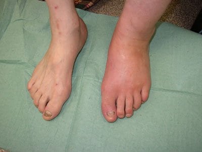 Красные пальцы на ногах лечение при сахарном диабете thumbnail