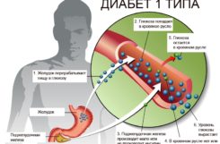 Основная разница между сахарным диабетом 1 и 2 типа