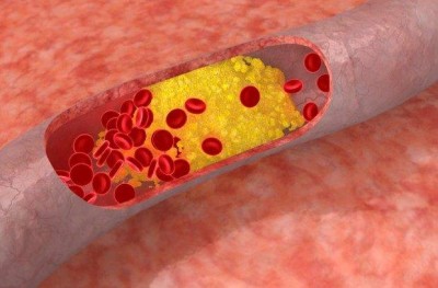 Зуд кожи при сахарном диабете у женщин: чешется в интимном месте, лечение