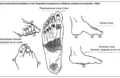 Терапия диабетической остеоартропатии
