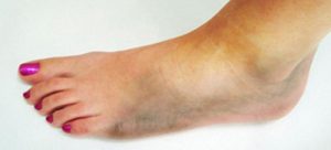 Гангрена ноги: фото, начальная стадия при сахарном диабете 1 и 2 типа