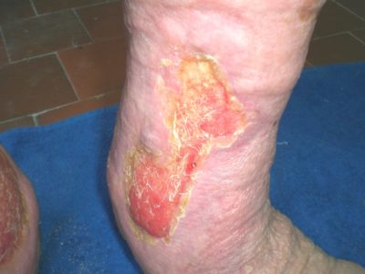 Трофическая язва на ноге: лечение при сахарном диабете