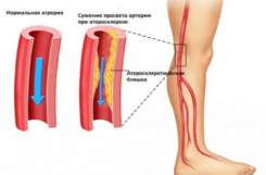 Ангиопатия при сахарном диабете