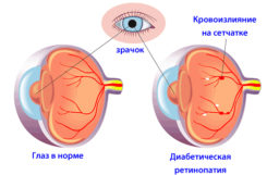 Ретинопатия при сахарном диабете