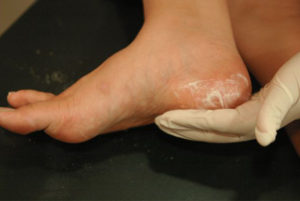Онемение пальцев, рук, ног при сахарном диабете - анемия конечностей