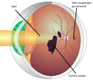 Диабетическая ретинопатия - что это такое, симптомы, лечение, виды