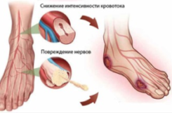 Диабетическая микроангиопатия нижних конечностей
