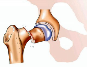 Перелом при сахарном диабете: причины перелома шейки бедра