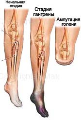 Ампутация ноги при сахарном диабете: пальца, стопы, области выше колена