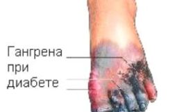 Гангрена нижних конечностей при сахарном диабете