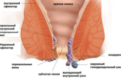 Геморрой при сахарном диабете