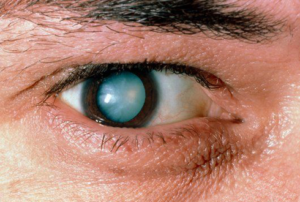 Зрение и диабет - ухудшение и потеря зрения, симптомы начала развития