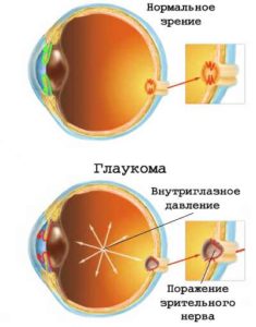 Зрение и диабет - ухудшение и потеря зрения, симптомы начала развития