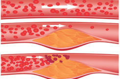 Диагностика атеросклероза: ультразвуковое, лабораторное исследование и лечение болезни