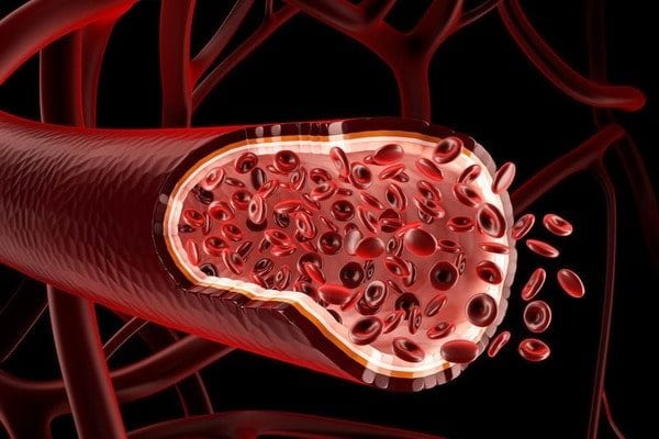 Атеросклероз аорты сердца: лечение народными средствами, отзывы о методах и рецептах