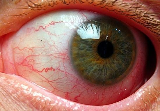 Атеросклероз сосудов глаза: лечение сетчатки и глазного дна