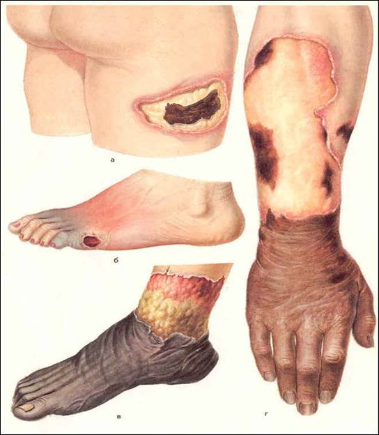 Ампутация ноги при сахарном диабете: почему при заболевании ампутируют пальцы, стопу