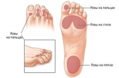 Язвы на ногах при сахарном диабете: лечение и стадии развития
