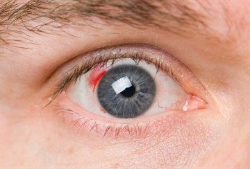 Можно ли делать операцию на глаза при сахарном диабете и какие есть еще варианты лечения