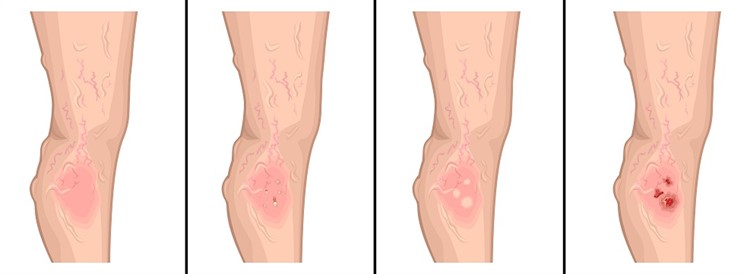 Язвы при сахарном диабете на ногах и руках: причины и лечение трофического поражения кожи