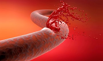 Диабетический гломерулосклероз: микропрепарат, причины возникновения и способы лечения