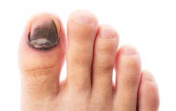 Уход за ногами при сахарном диабете, лечение трещин на пятках и грибка