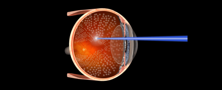 Диабетическая ретинопатия: лечение при сахарном диабете, симптомы и виды