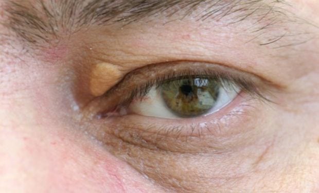 Холестериновые бляшки на веках: как избавиться от отложений холестерина на глазах?