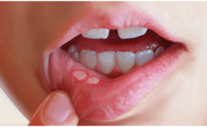 Проявление сахарного диабета в полости рта: стоматит и глоссит у диабетиков