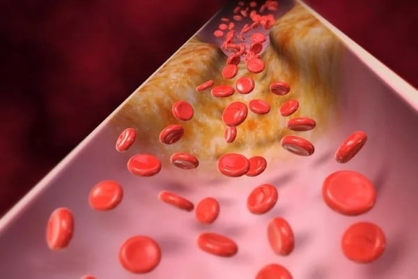 Цветы липы от холестерина: как принимать до еды или после, противопоказания и рецепты