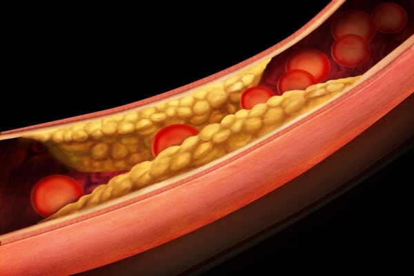 Холестерин 20 в организме: что это означает и как быть при таком показателе?